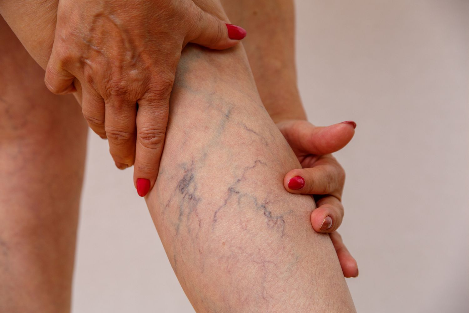 Costa Rica Spider and Varicose Vein Treatments